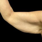 Arm Lift Before & After Patient #5659