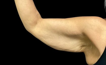 Arm Lift Before & After Patient #5659