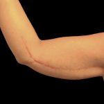 Arm Lift Before & After Patient #5659