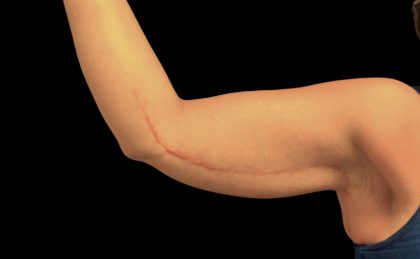 Arm Lift Before & After Patient #5659
