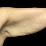 Arm Lift Before & After Patient #5659
