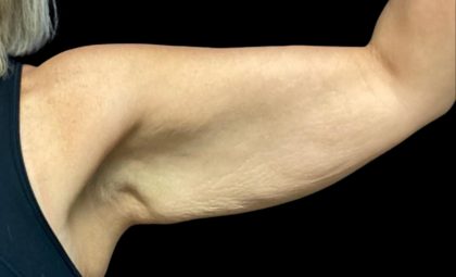 Arm Lift Before & After Patient #5659