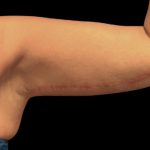 Arm Lift Before & After Patient #5659