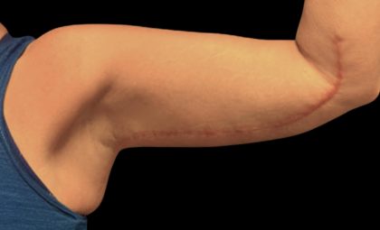 Arm Lift Before & After Patient #5659