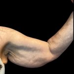 Arm Lift Before & After Patient #5660