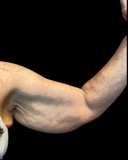 Arm Lift Before & After Patient #5660