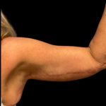 Arm Lift Before & After Patient #5660