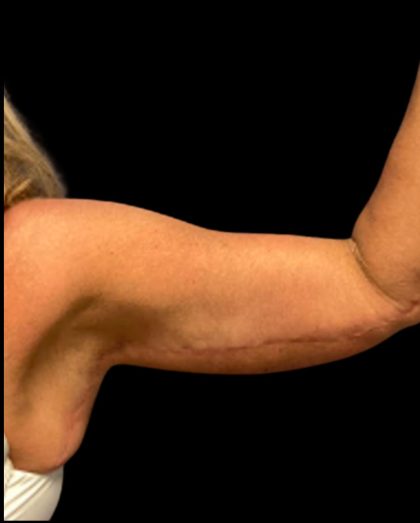 Arm Lift Before & After Patient #5660
