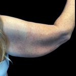Arm Lift Before & After Patient #5660