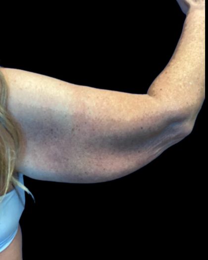 Arm Lift Before & After Patient #5660