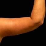 Arm Lift Before & After Patient #5660