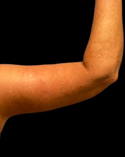 Arm Lift Before & After Patient #5660