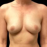 Breast Augmentation Before & After Patient #5596