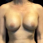 Breast Augmentation Before & After Patient #5596