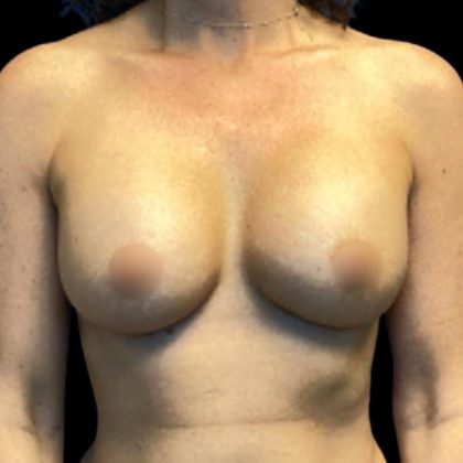 Breast Augmentation Before & After Patient #5596