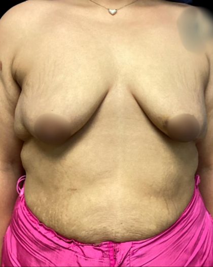 Breast Augmentation Before & After Patient #5662