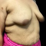 Breast Augmentation Before & After Patient #5662