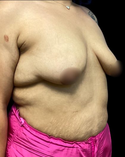Breast Augmentation Before & After Patient #5662
