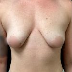 Breast Augmentation Before & After Patient #5661