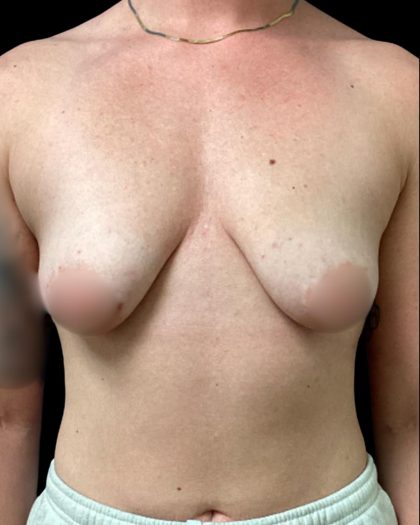 Breast Augmentation Before & After Patient #5661