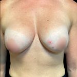 Breast Augmentation Before & After Patient #5661
