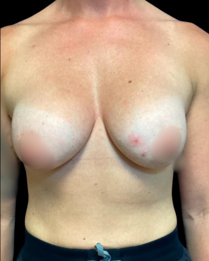 Breast Augmentation Before & After Patient #5661