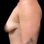 Breast Augmentation Before & After Patient #5661