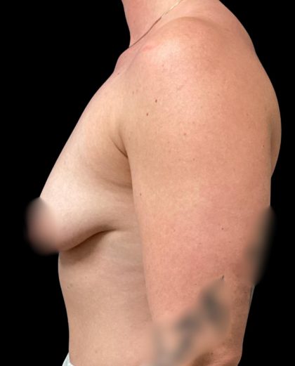 Breast Augmentation Before & After Patient #5661