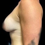 Breast Augmentation Before & After Patient #5661