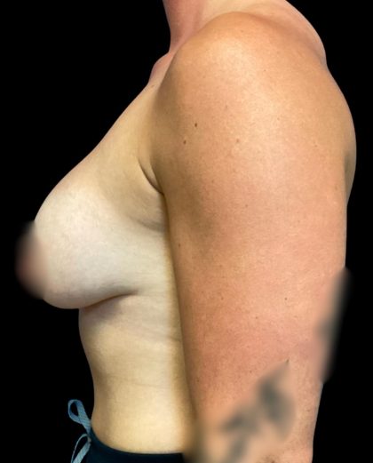 Breast Augmentation Before & After Patient #5661