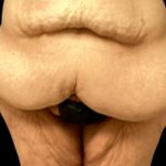 Tummy Tuck Before & After Patient #5599
