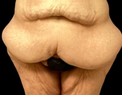 Tummy Tuck Before & After Patient #5599