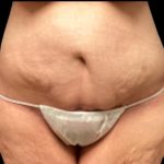 Tummy Tuck Before & After Patient #5599