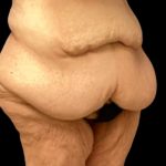 Tummy Tuck Before & After Patient #5599