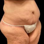 Tummy Tuck Before & After Patient #5599