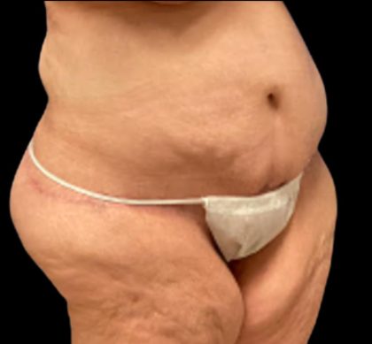 Tummy Tuck Before & After Patient #5599