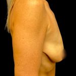 Breast Lift Before & After Patient #5663