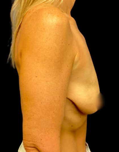 Breast Lift Before & After Patient #5663