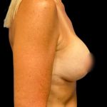 Breast Lift Before & After Patient #5663