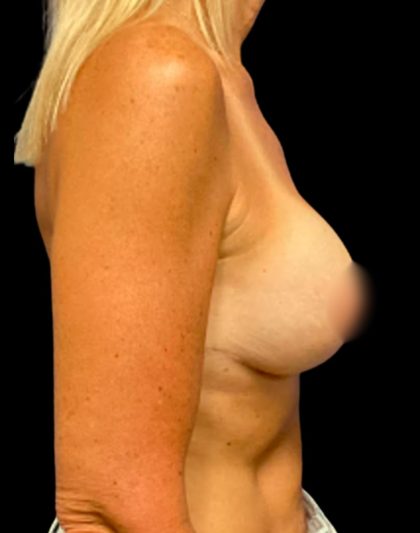 Breast Lift Before & After Patient #5663