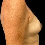 Breast Reconstruction Before & After Patient #5664