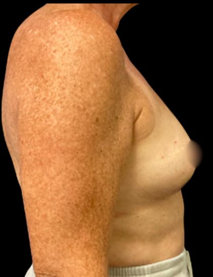Breast Reconstruction Before & After Patient #5664