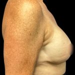 Breast Reconstruction Before & After Patient #5664