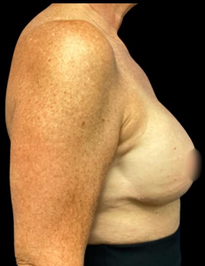 Breast Reconstruction Before & After Patient #5664