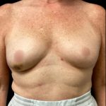 Breast Reconstruction Before & After Patient #5664
