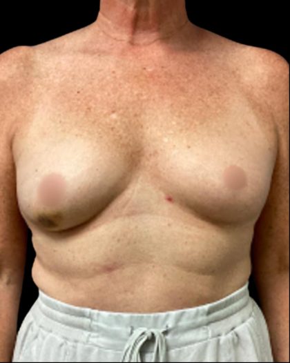 Breast Reconstruction Before & After Patient #5664