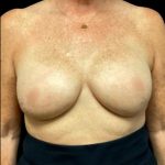 Breast Reconstruction Before & After Patient #5664