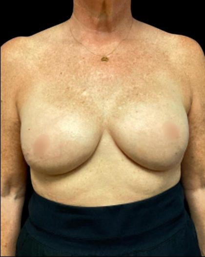 Breast Reconstruction Before & After Patient #5664
