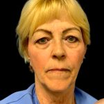 Blepharoplasty Before & After Patient #5640