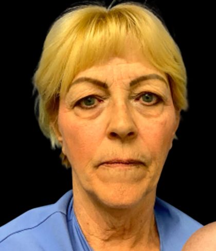 Blepharoplasty Before & After Patient #5640